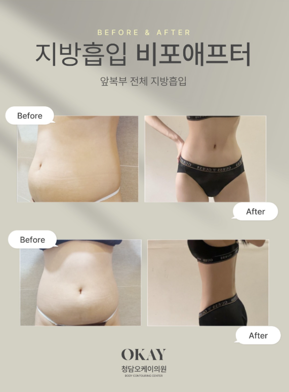 복부지방흡입가격과 효과 비례할까? 허리라인·복부라인 디자인 차이 관련 이미지 5