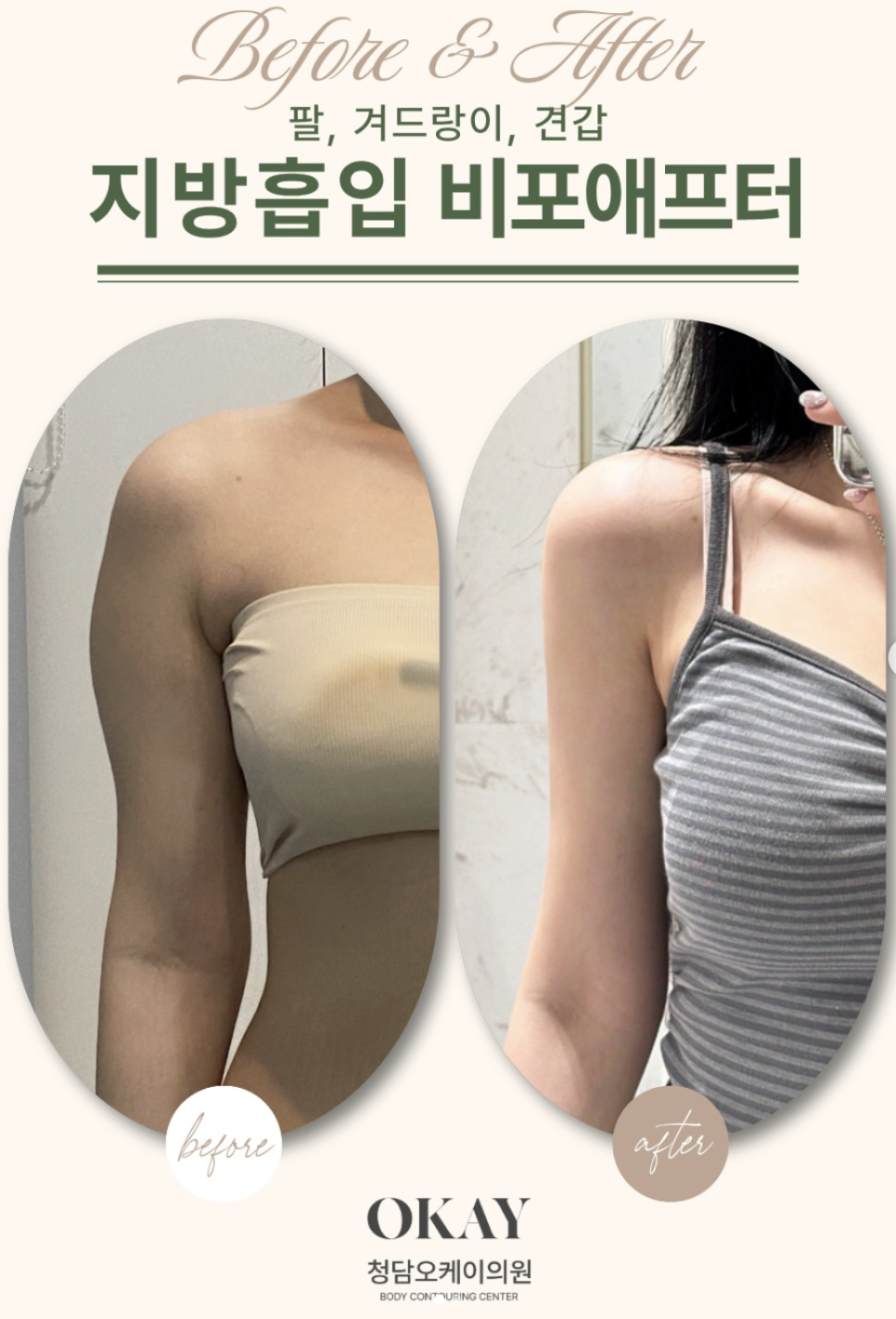 Cheongdam Station Plastic Surgery Liposuction: 3 Differences That Determine Satisfaction image 10