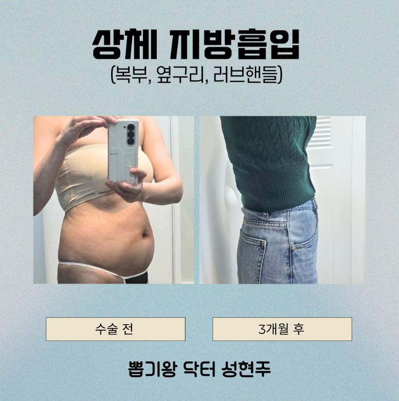 청담역성형외과 복부지방흡입, 효과 제대로 보는 사람들의 공통점 관련 이미지 6