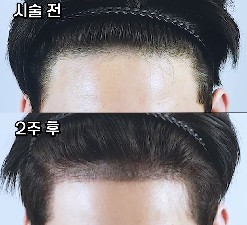 모발이식 3000모, 많을수록 좋은 걸까요? 관련 이미지 2