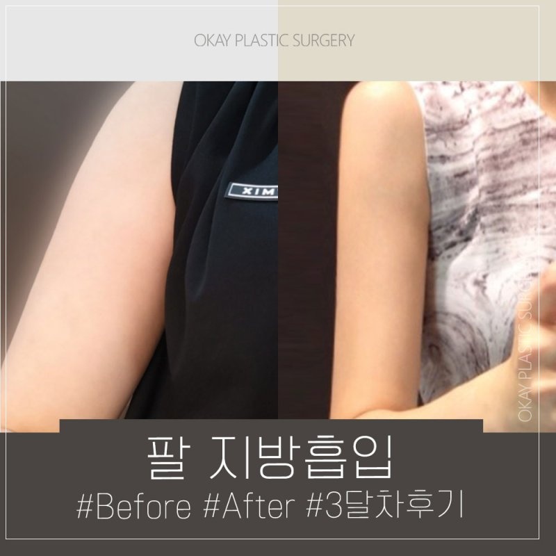 팔뚝지방흡입후관리 어떻게 해야 할까? 붓기&middot;통증&middot;멍 줄이는 회복 기간 관리 방법 정리 관련 이미지 8