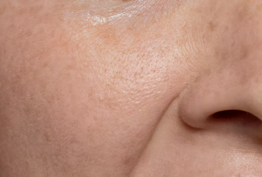 팔자주름 지방이식 전후 차이 얼마나 날까? 가격과 생착률, 유지기간까지 정리해드립니다 관련 이미지 2