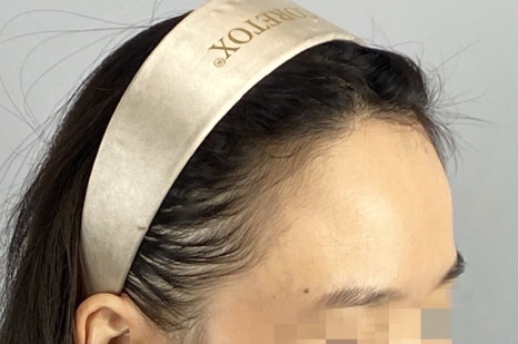 강남 여자모발이식잘하는곳 3000모가 맞을까? 비용&middot;통증&middot;생착률&middot;디자인과 사후관리 관련 이미지 4