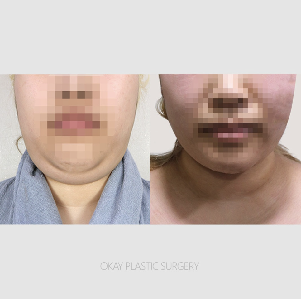 이중턱지방흡입, 하고 나서 만족하는 사람들은 무엇이 달랐을까? 관련 이미지 9