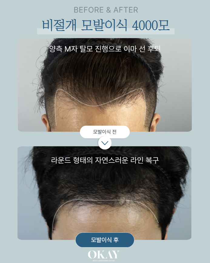 Non-Incisional Hair Transplantation: What to Check for Natural-Looking Results image 8