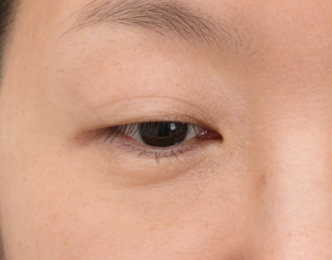 How Much Difference Does Facial Autologous Fat Grafting Make Before and After? A Summary of Duration, Swelling, and Survival Rate image 5