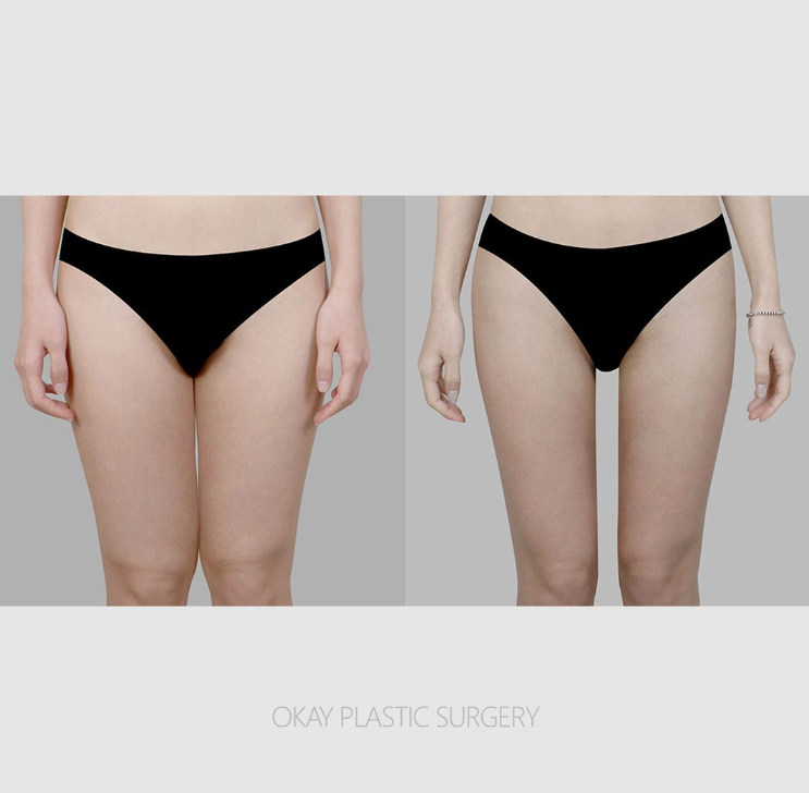 지방흡입잘하는병원 찾는다면? 부위보다 중요한 건 전체 라인 관련 이미지 9