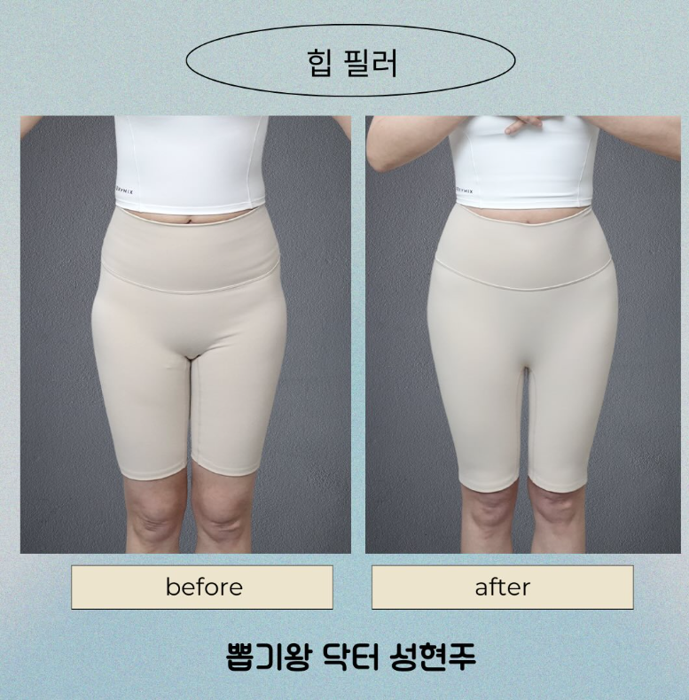 힙딥필러, 땅콩골반이 스트레스라면? 전후 변화&middot;용량&middot;유지기간까지 정리 관련 이미지 5