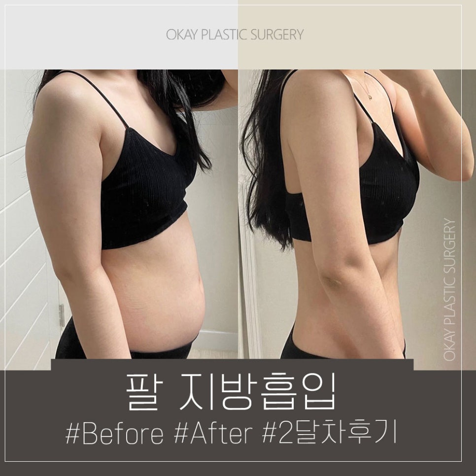 여자 부유방 vs 남자 부유방, 지방 vs 유선 차이부터 확인하세요 관련 이미지 8