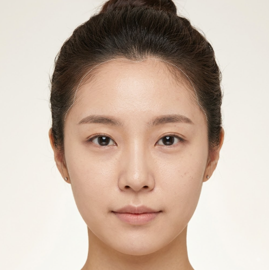 헤어라인모발이식, 얼굴형에 따라 디자인이 달라지는 이유 관련 이미지 6