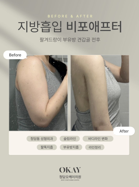 팔지방흡입 후기, 가격 차이 나는 이유 직접 알아봤습니다 관련 이미지 5