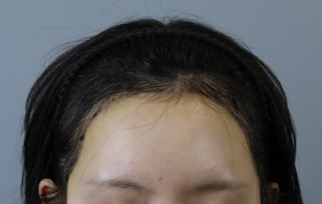 Why Results End Up Bad After Finding a ‘Hair Transplant Hotspot’ Clinic in Seoul: This Is Where It Comes Down to the Details image 11