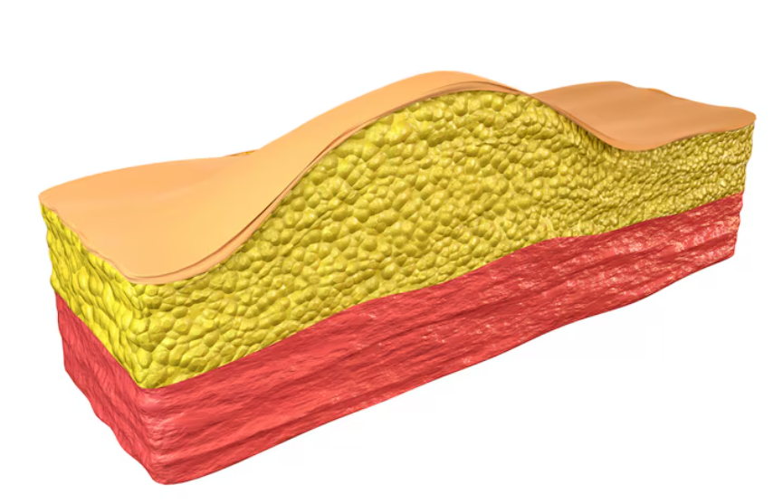 Why Is a Good Place for Liposuction Revision Surgery Important? Causes of Failure and Correction Methods image 4