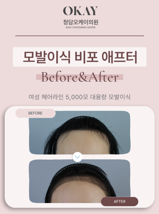 M자모발이식, 심은 머리가 다시 빠질 수도 있을까? 관련 이미지 6