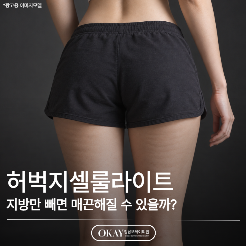 허벅지셀룰라이트, 지방만 빼면 매끈해질 수 있을까? 관련 이미지 1