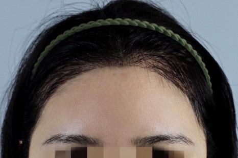 강남 여자모발이식잘하는곳 3000모가 맞을까? 비용&middot;통증&middot;생착률&middot;디자인과 사후관리 관련 이미지 7