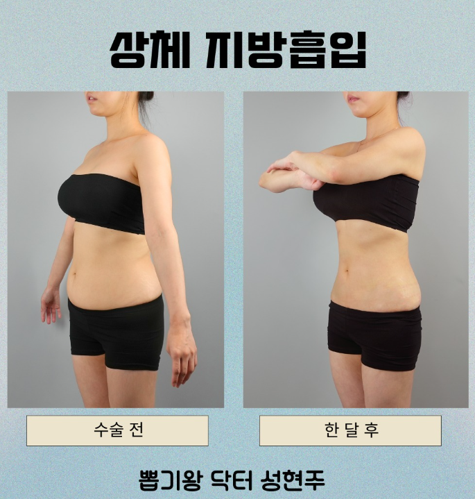 아랫배빼는법, 복부지방은 무조건 많이 빼면 될까? 관련 이미지 6