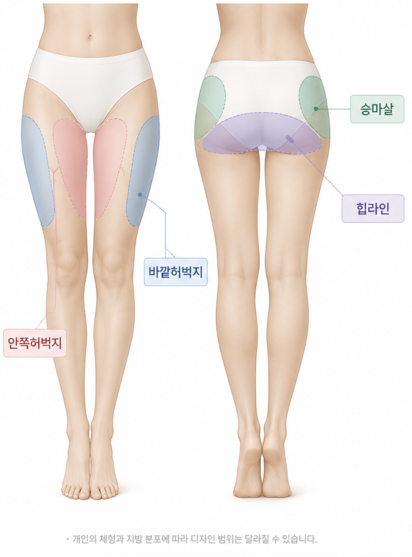 허벅지지방흡입 출근, 며칠부터 가능할까요? 회복 과정 함께 알아보기 관련 이미지 5