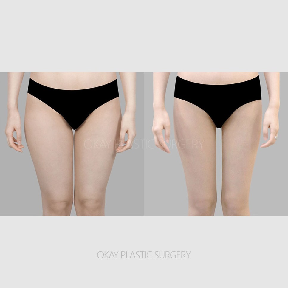 다리지방흡입 후기마다 결과가 다른 진짜 이유 관련 이미지 9