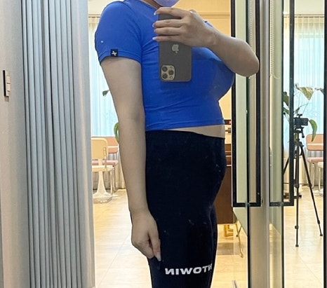 How to Find a Good Liposuction Clinic Near Gangnam Station: Hospital Selection Criteria and the Difference Between Reviews and Actual Results image 9