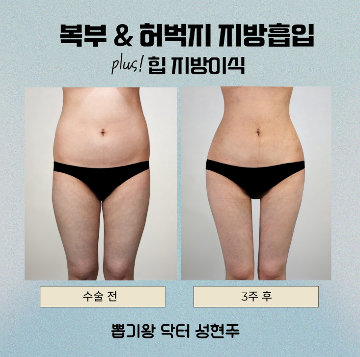 대용량 지방흡입 부작용 있을까? 안전하게 받기 위한 핵심 포인트 관련 이미지 9