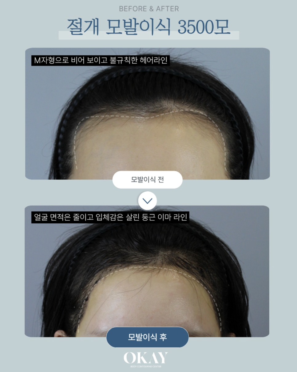 헤어라인모발이식, 실패를 줄이기 위해 꼭 확인해야 할 5가지 관련 이미지 5