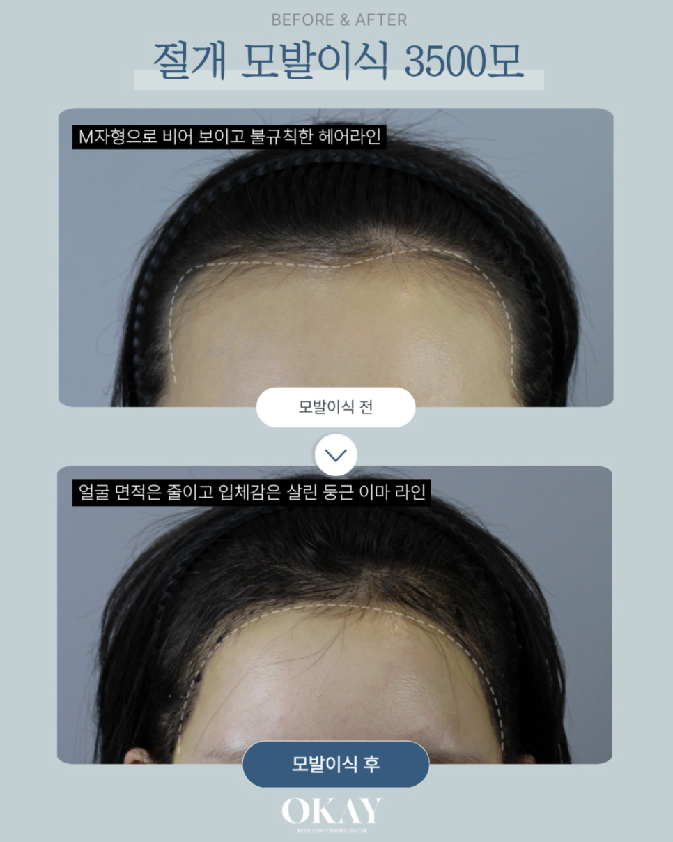 강남탈모병원, 언제부터 모발이식을 고려해야 할까요? 관련 이미지 10