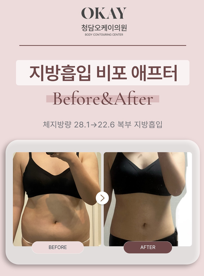 압구정로데오 성형외과, 지방흡입은 양보다 디자인입니다 관련 이미지 5