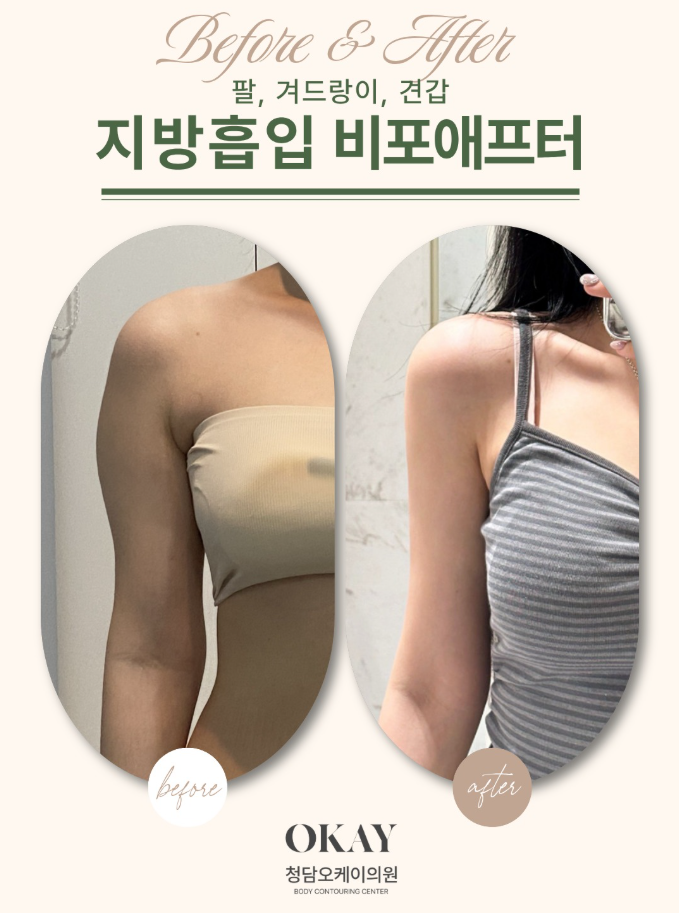지흡흉터 언제 흐려질까? 치료·레이저·관리 방법 함께 정리 관련 이미지 9