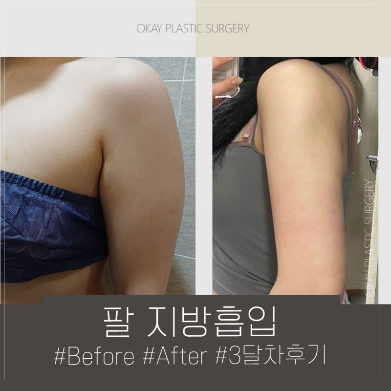 청담동성형외과 잘하는곳 찾는다면 재수술 상담에서 확인해야 할 기준 관련 이미지 11