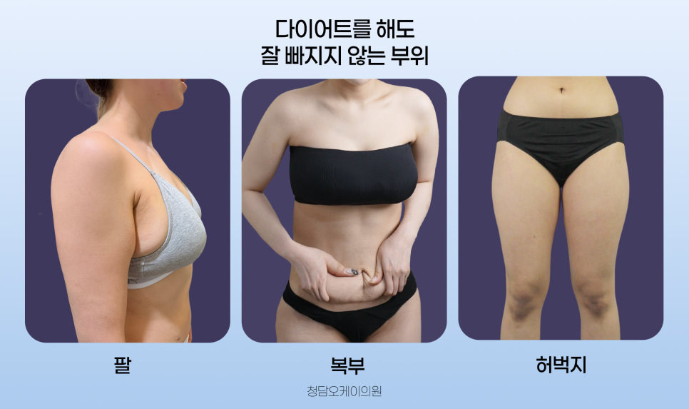 [청담오케이의원] 지방흡입 먼저? 다이어트 먼저? 관련 이미지 1