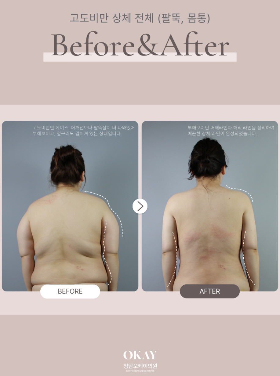 Liposuction for Severe Obesity: What Must Be Checked When Performing Large-Volume Liposuction? image 7