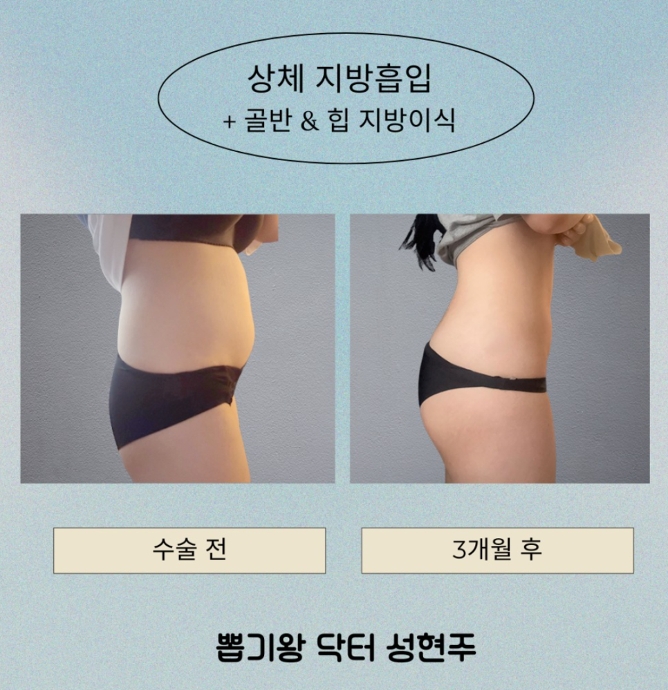 엉덩이지흡, 엉밑살 빼면 처짐과 힙딥까지 좋아질까? 관련 이미지 10
