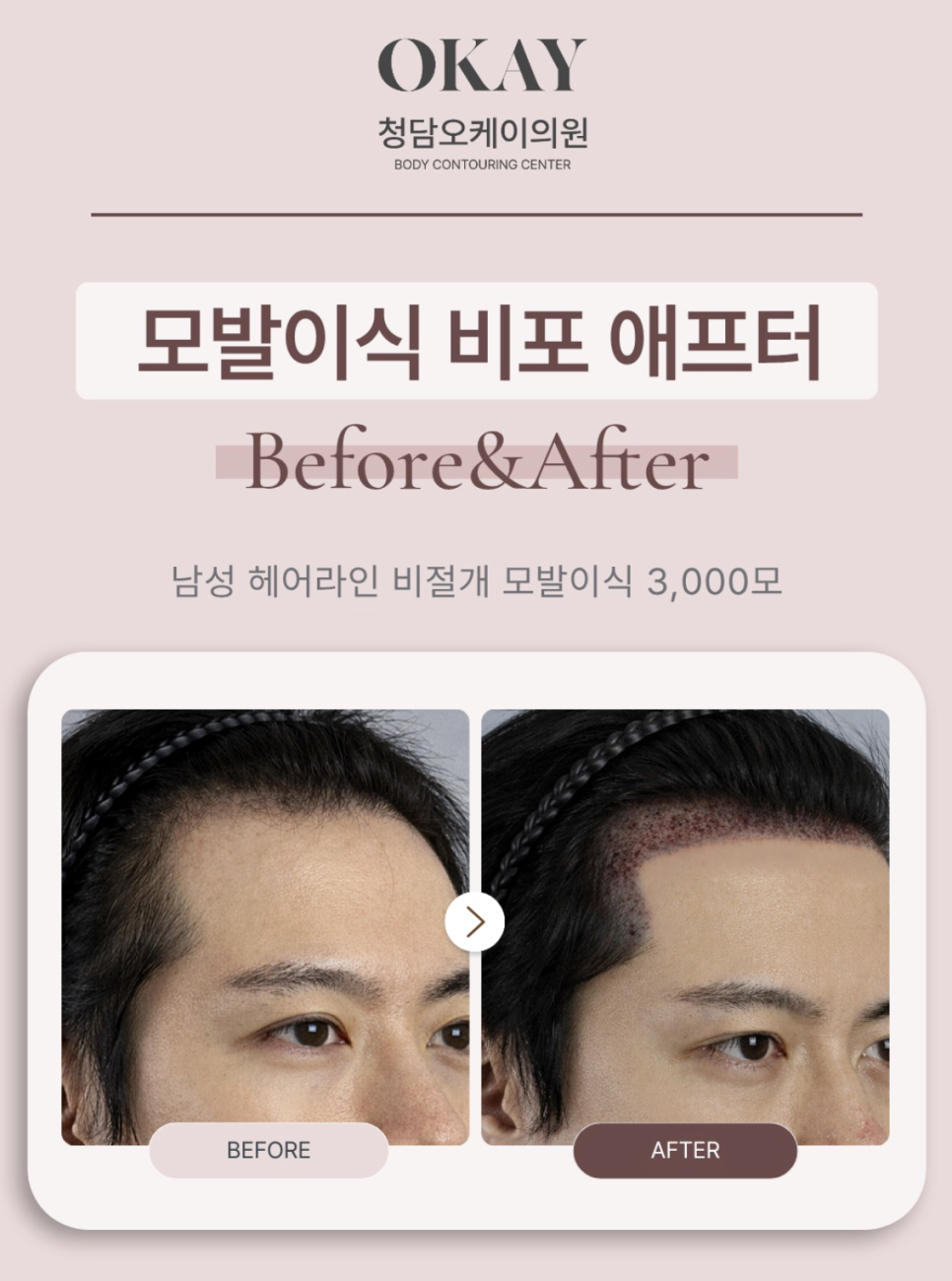 모발이식생착기간, 언제부터 안심해도 될까요? 딱지·운동·모자까지 총정리 관련 이미지 2