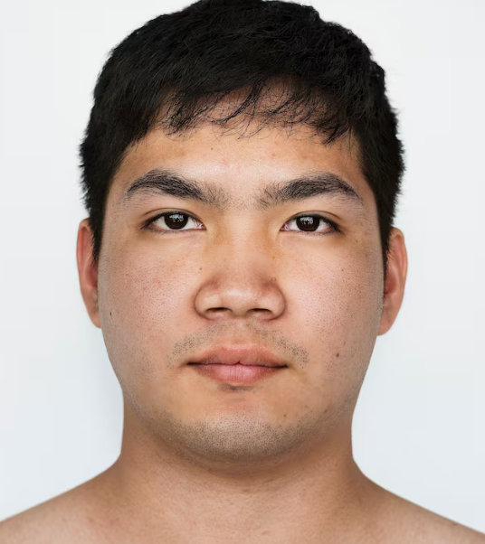 서울 남자얼굴지방흡입 효과 있을까? 턱살&middot;윤곽이 다이어트로 안되는 이유와 가격 관련 이미지 2