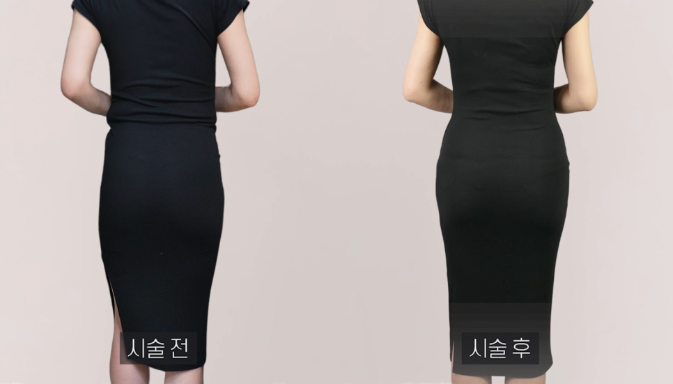 강남 압구정 엉덩이필러잘하는곳, 자연스러움은 꼼꼼함에서 갈립니다 몇 cc&middot;붓기&middot;멍 정리 관련 이미지 5