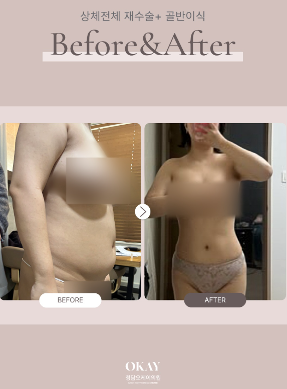 강남성형외과, 운동해도 안 빠지는 살 지방흡입이 답일까요? 관련 이미지 8