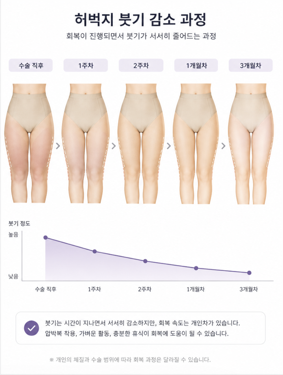 Bruising · Swelling · Dimpling After Thigh Liposuction—Are They Part of the Normal Recovery Process? image 6