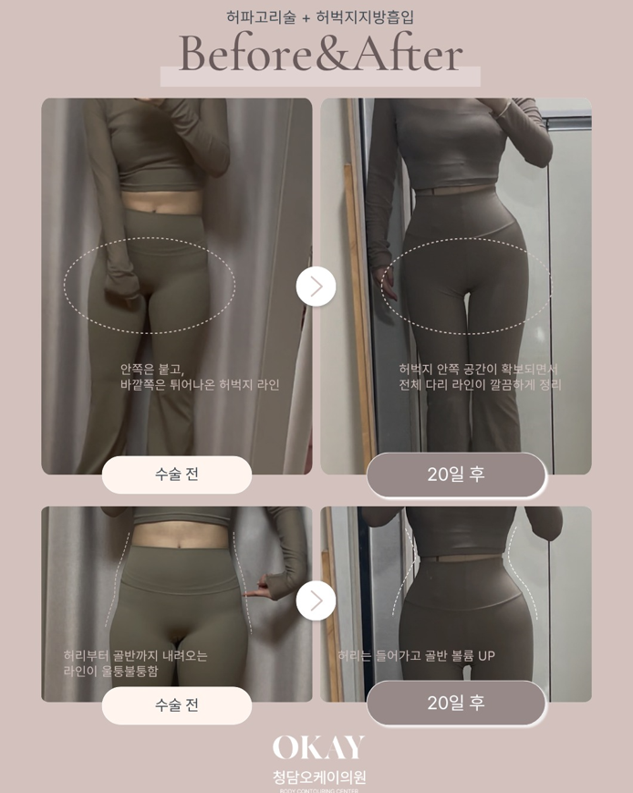 골반지방이식 후 부작용, 자연스러운 라인을 위해 확인해야 할 기준 관련 이미지 8