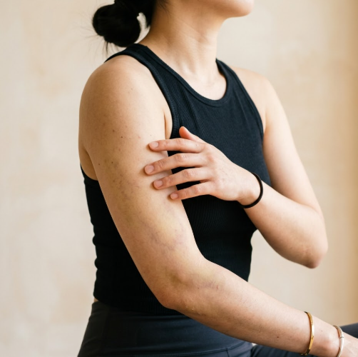 From 2 Weeks to 3 Months After Arm Liposuction: How Does the Arm Contour Change? image 4