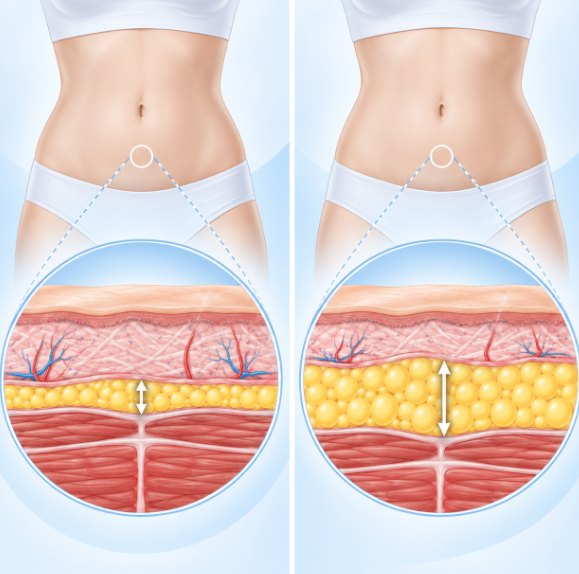 압구정지방분해주사, 운동해도 안 빠지는 뱃살에 효과 있을까? 관련 이미지 8