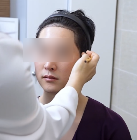 강남 비절개 모발이식, 뒷머리 숱까지 줄어드는 건 아닐까? 관련 이미지 9