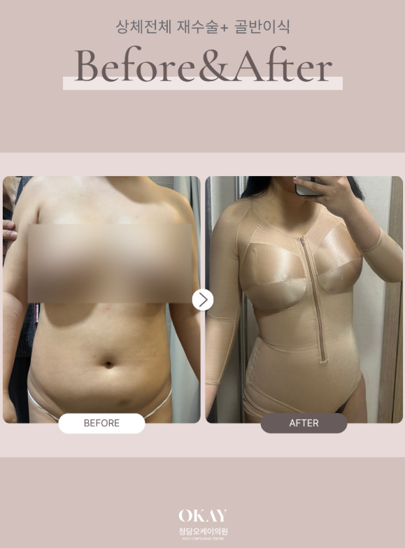 지방분해주사 지방흡입, 같은 지방 제거인데 무엇이 다를까요? 관련 이미지 8