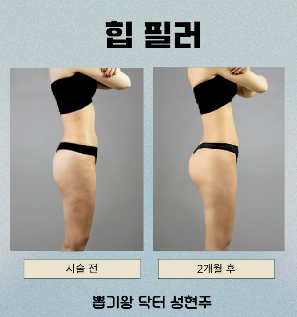 엉덩이지방이식 후 만족도가 갈리는 결정적 차이 관련 이미지 10
