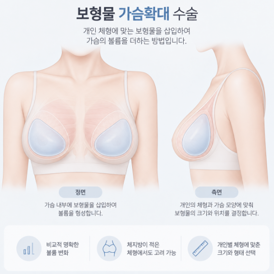 신사역가슴확대수술, 보형물과 지방이식 어떤 차이가 있을까요? 관련 이미지 3