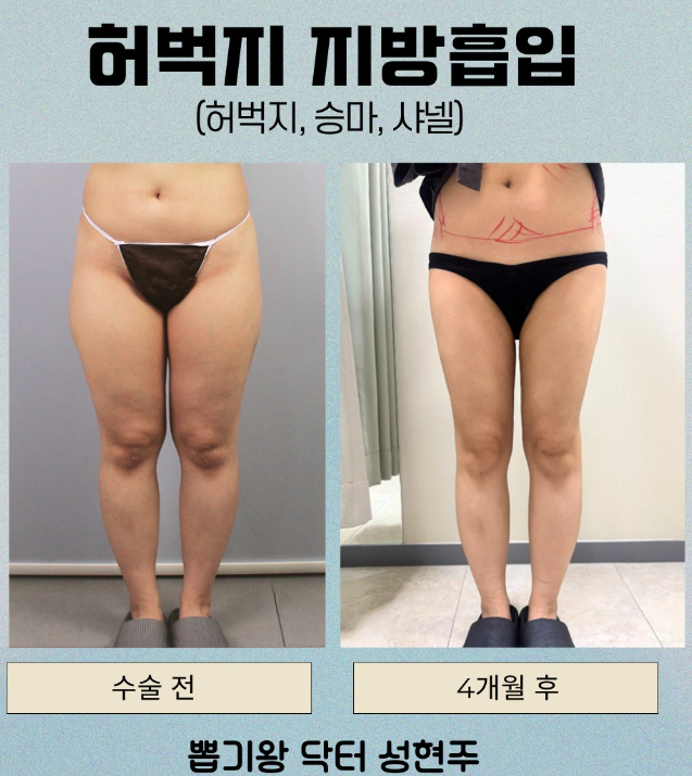 허벅지지방흡입, 다리가 두꺼워 보이는 이유가 지방 때문일까? 관련 이미지 6