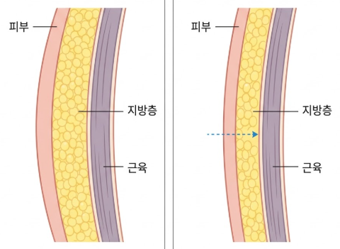 팔지방흡입 후기, 가격 차이 나는 이유 직접 알아봤습니다 관련 이미지 9