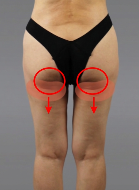 Subgluteal Liposuction: Why Results Differ Depending on Skin Elasticity and Sagging image 6