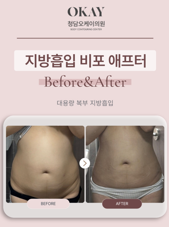 압구정성형외과, 지방흡입과 지방이식 차이 알려드립니다 관련 이미지 5