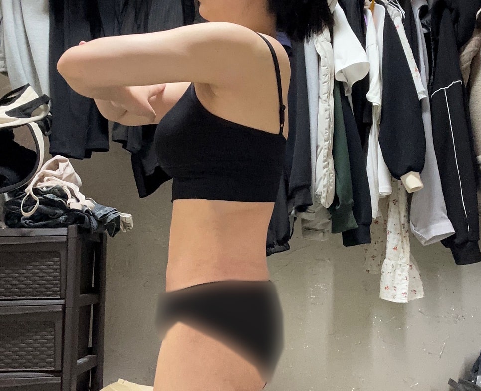 Liposuction Surgery Method: The Truth and Misconceptions About Pain, Bruising, and Side Effects, Directly Explained by the Director image 6